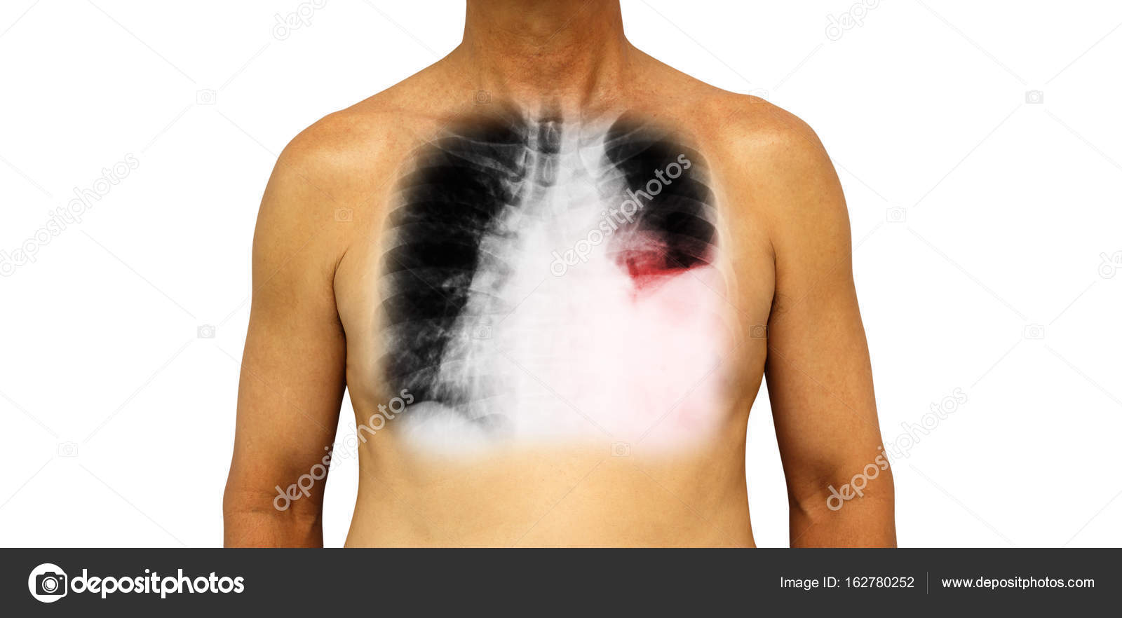Lung cancer . Human chest and xray show pleural effusion left lung due