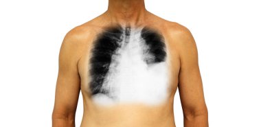 Lung cancer . Human chest and x-ray show pleural effusion left lung due to lung cancer clipart