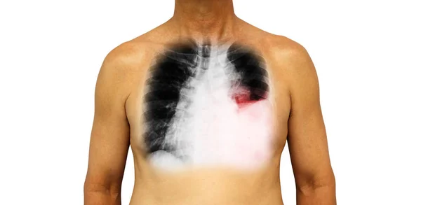 Cancro ai polmoni. Torace umano e radiografia mostrano versamento pleurico polmonare sinistro a causa di cancro ai polmoni — Foto Stock