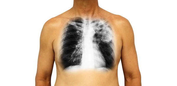 Tubercolosi polmonare. Il torace umano con raggi X mostra infiltrazione frammentaria del polmone superiore sinistro a causa di infezione. Fondo isolato — Foto Stock