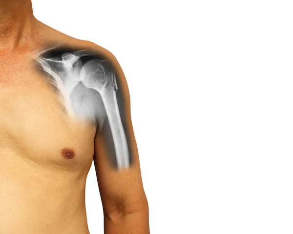 La spalla umana con raggi X mostra frattura al collo dell'omero (osso del braccio). Sfondo isolato. Area vuota sul lato destro — Foto Stock