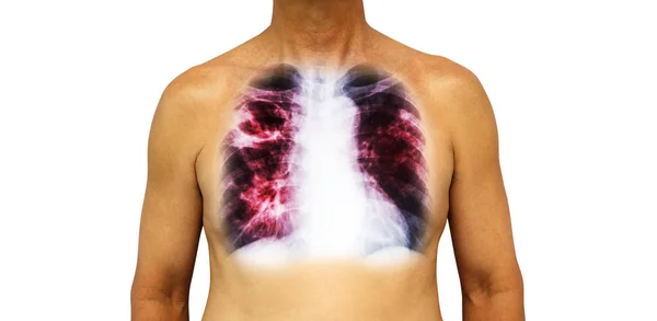 Tubercolosi polmonare. Il torace umano con raggi X mostra cavità nel polmone superiore destro e infiltrazione interstiziale in entrambi i polmoni a causa di infezione. Fondo isolato — Foto Stock