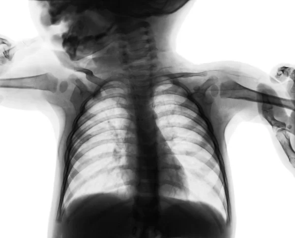 Film chest x-ray of child . isolated background — Stock Photo, Image