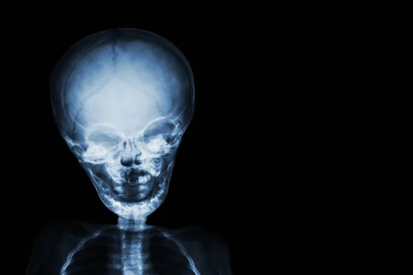 Film Röntgenschädel und Körper des Kindes und weiße Stelle an der rechten Seite — Stockfoto
