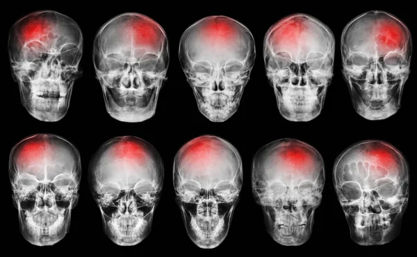 Stroke . Cerebrovascular accident . Set of film x-ray skull — Stock Photo, Image