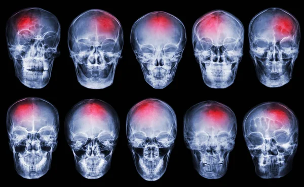 Un derrame. Accidente cerebrovascular. Conjunto de cráneo de rayos X de película — Foto de Stock