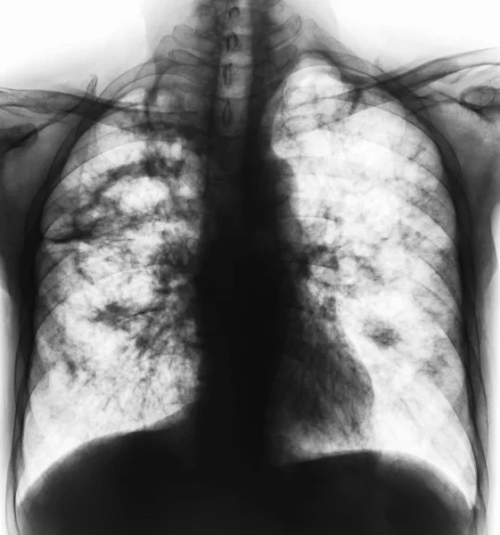 A tuberculose pulmonar. Radiografia radiológica de tórax mostra cavidade no pulmão direito e infiltrado intersticial ambos os pulmões devido à infecção por TB — Fotografia de Stock