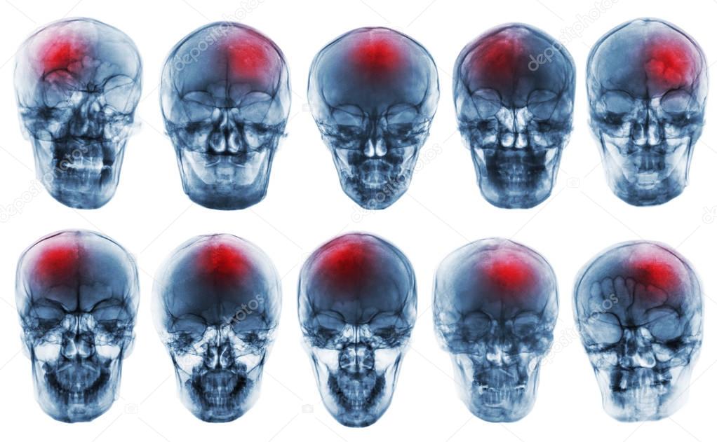 Stroke . Cerebrovascular accident . Set of film x-ray skull