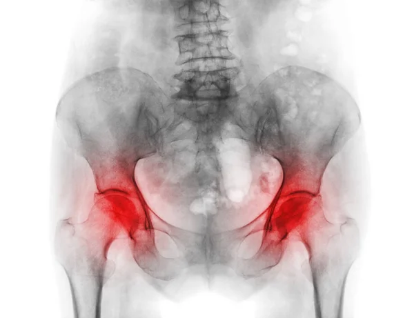 Film radiographie du bassin du patient atteint d'ostéoporose et d'arthrite de la hanche — Photo