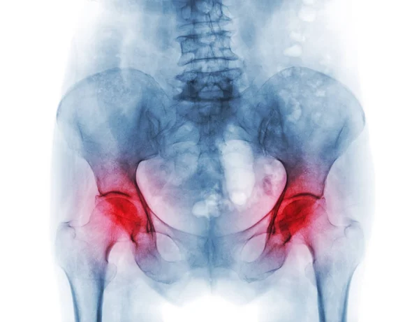 Película de rayos X de la pelvis de la osteoporosis paciente y la artritis tanto de cadera — Foto de Stock