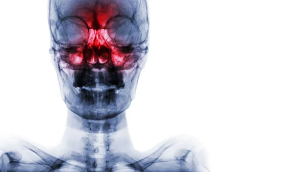 Sinusite no seio frontal, etmoidal, maxilar. Raios-X de filme de crânio e área em branco no lado direito — Fotografia de Stock
