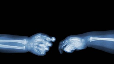 Bebeğin x-ray ve üst tarafında boş alanı eller. (El sallamak). İzole