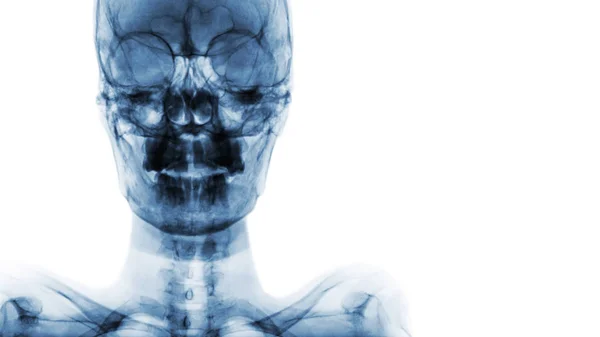 Filme X-ray Crânio AP: mostrar crânio humano normal e área em branco no lado direito — Fotografia de Stock