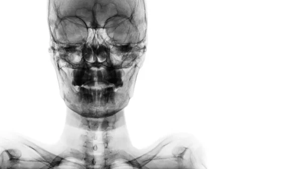 Film x-ray schedel Ap: Toon normale menselijke schedel en leeg gebied aan rechterkant — Stockfoto