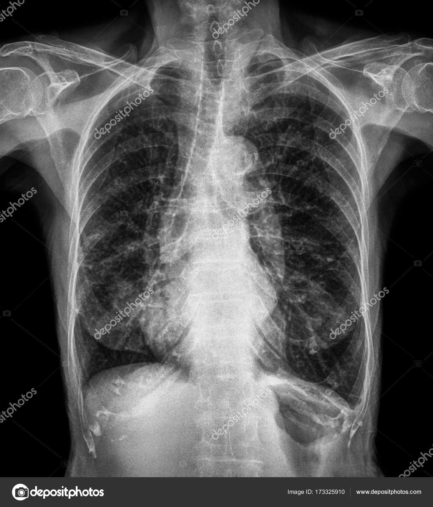 normal chest xray normal chest xray