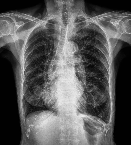 Normální hrudníku X-ray starého pacienta. Můžete vidět kalcifikace na žebra, průdušnice, průdušky. Pohled zepředu — Stock fotografie