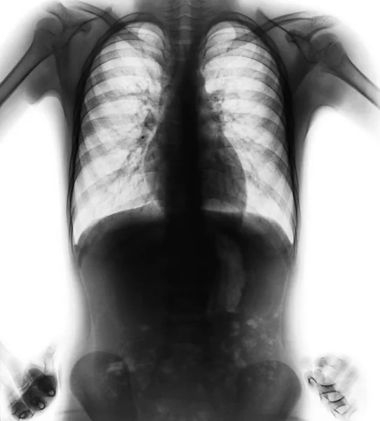 Звичайний рентгенівський знімок грудної клітки (позиція акімбо) (перегляд спереду  ) — стокове фото