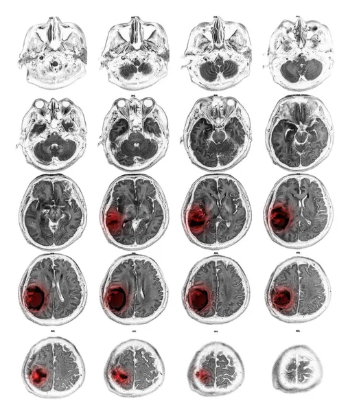 右顶叶脑肿瘤的 Mri 表现 — 图库照片