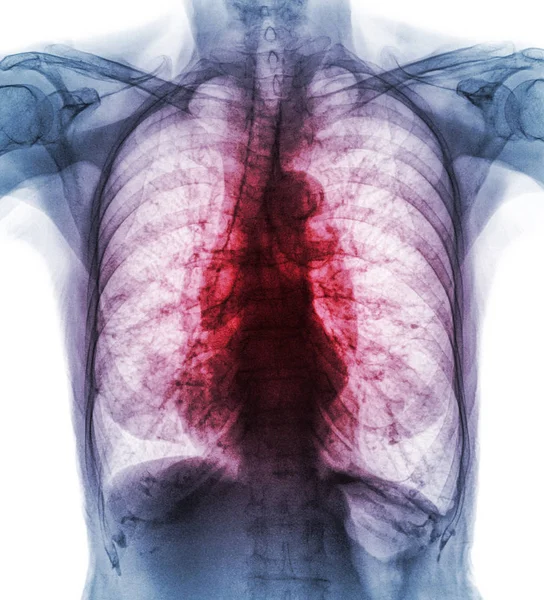 Tuberculose pulmonar. Radiografia de tórax mostra infiltrado intersticial ambos os pulmões devido à infecção por Mycobacterium tuberculosis — Fotografia de Stock