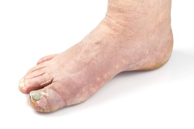 Ayak tırnağı mantarı beyazda izole edilmiş. Yaralı ayak tırnağı, tırnak mantarı. Yakın plan fotoğraf.