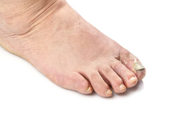 Fungo dell'unghia del piede isolato su bianco. Unghie del piede dolorante, chiodo fungo foto da vicino — Foto Stock