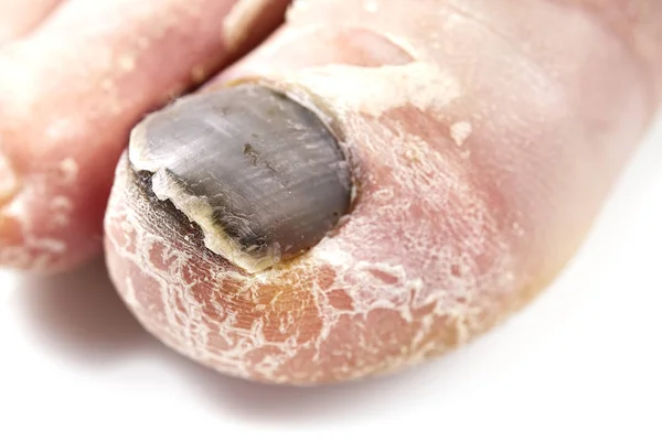 Toenail fungus isolated on white. Sore toenail, nail fungus close up photo — Stock Photo, Image