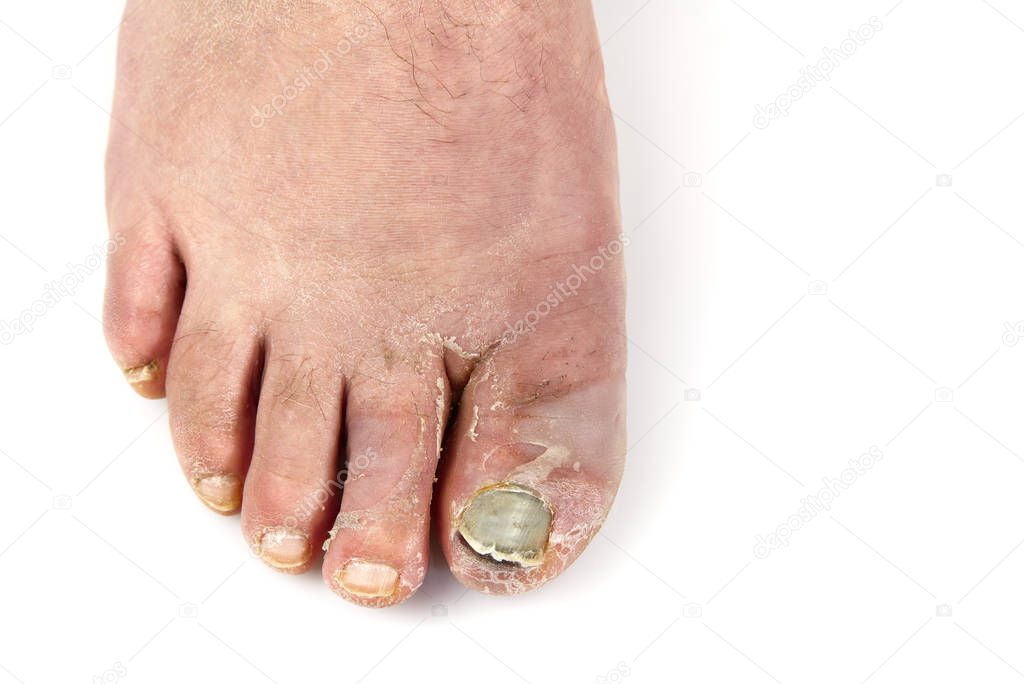 Toenail fungus isolated on white. Sore toenail, nail fungus close up photo