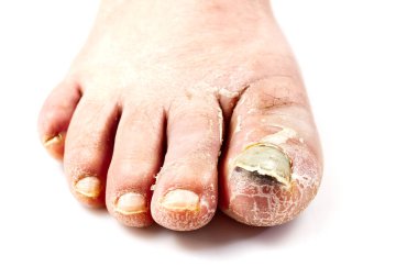 Sick nail on the foot. Toenail fungus isolated on white. Sore toenail, nail fungus close up photo