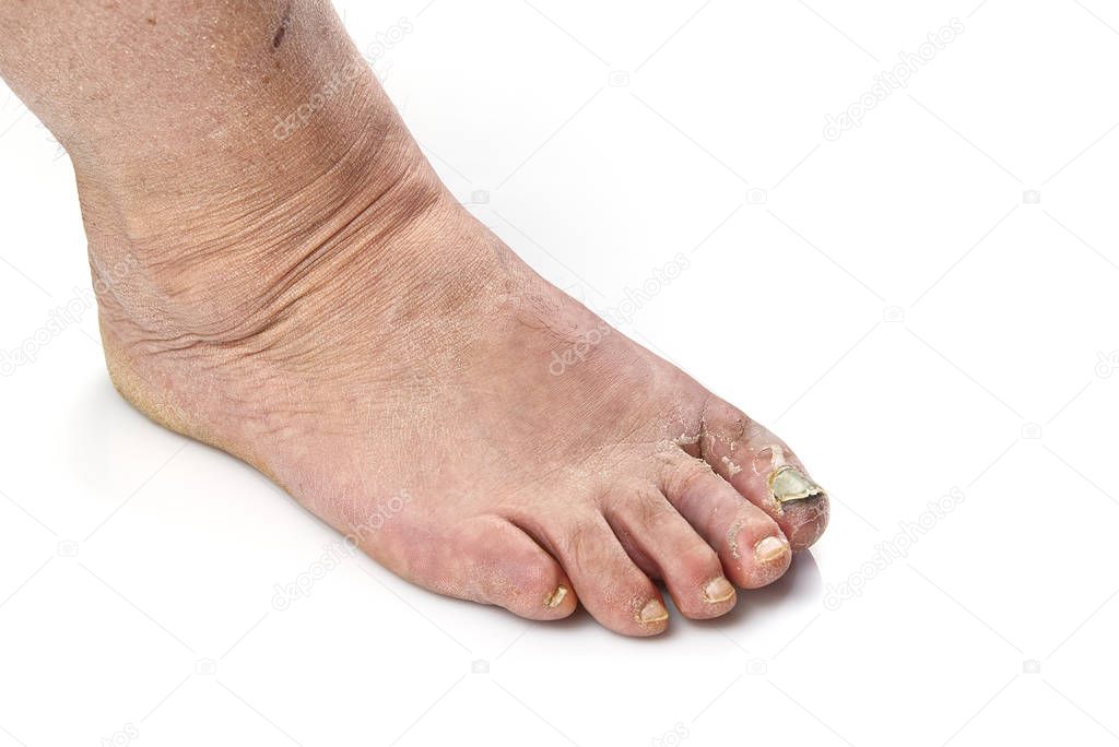 Sick nail on the foot. Toenail fungus isolated on white. Sore toenail, nail fungus close up photo