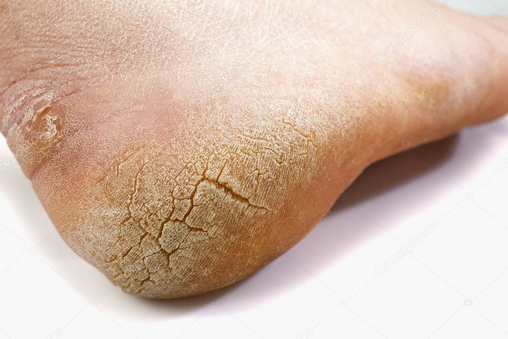 Cracked toe. Macro. White background. Pain denoted by the red color