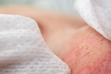 Güzellik uzmanı genç ve güzel bir kızın yüzündeki sivilceleri alıyor. Kozmetik bilimi kavramı. Kozmetik uzmanı, yüzü sorunlu ciltlerle temizlemek için prosedürü uygular..