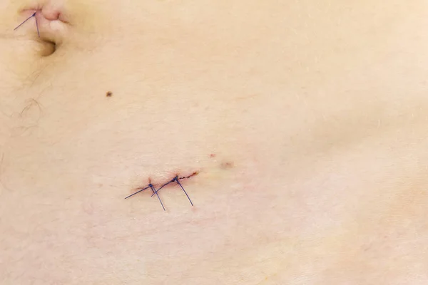 Body scars after appendicitis removal. Small and neat scars after Laparoscopy surgery. young bodey.