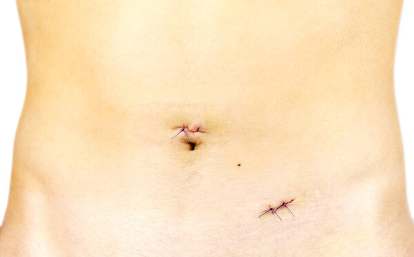 Body scars after appendicitis removal. Small and neat scars after Laparoscopy surgery. young bodey.