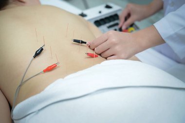 Elektro akupunktur. Geleneksel Çin akupunktur ve elektroa.