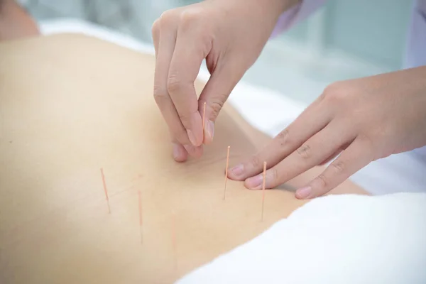Closeup, patient getting acupuncture from acupuncturist at clini