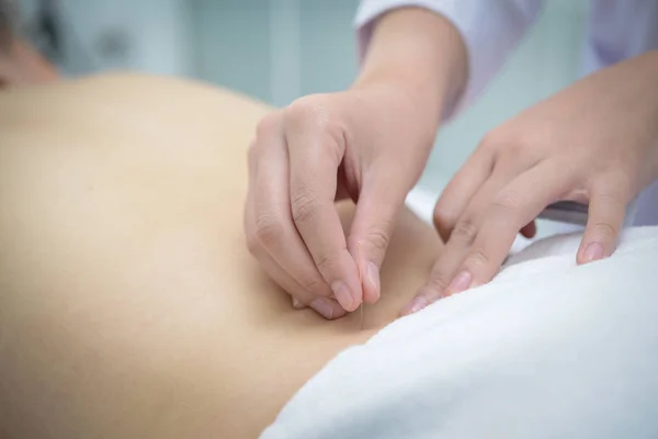 Closeup, patient getting acupuncture from acupuncturist at clini