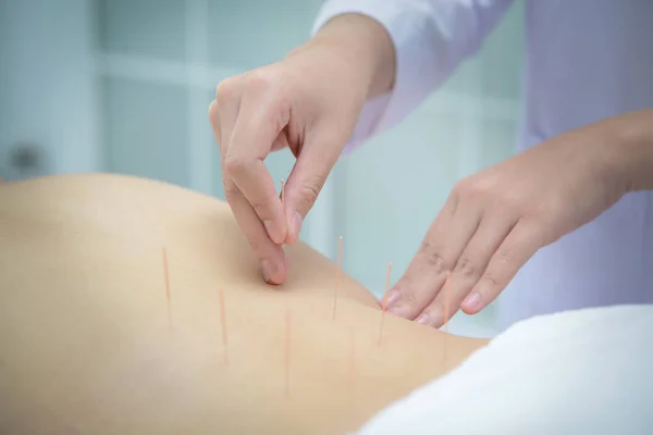 Close-up, patiënt krijgt acupunctuur van acupuncturist in clini — Stockfoto