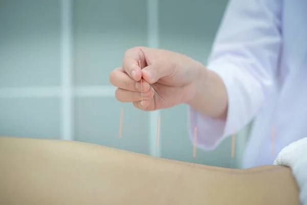 Primer plano, paciente recibiendo acupuntura de acupunturista en clini —  Fotos de Stock