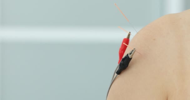 Electro Agopuntura Tradizionale Agopuntura Cinese Elettroagopuntura Sul Corpo Del Paziente — Video Stock