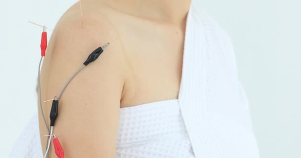 Electro Acupuncture Παραδοσιακός Κινεζικός Βελονισμός Και Ηλεκτροβελονισμός Στο Σώμα Του — Αρχείο Βίντεο