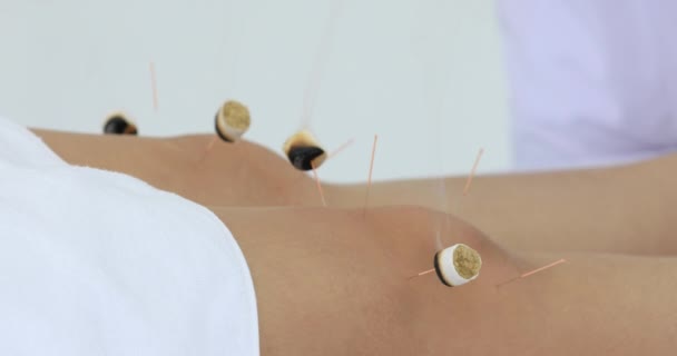 電気鍼治療 患者の体に伝統的な中国の鍼治療と電気鍼治療 — ストック動画