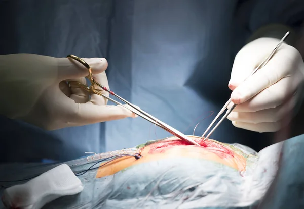 外科医生在无菌手套针夹紧缝合的伤口 — 图库照片