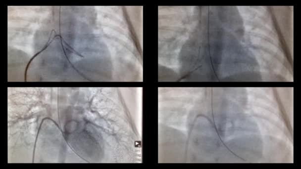 Catheterisatie van het hart en de schepen in de x-stralen — Stockvideo