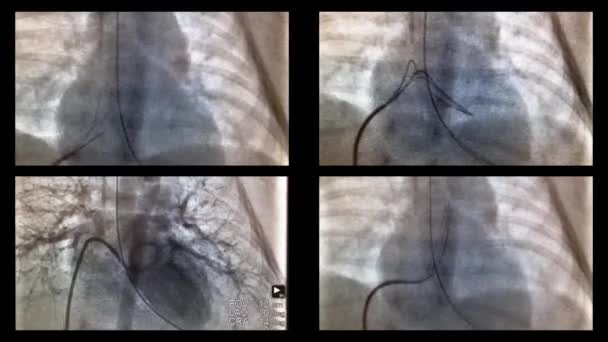 Catheterisatie van het hart en de schepen in de x-stralen — Stockvideo
