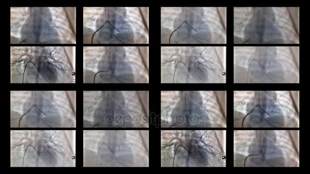 Катетеризация сердца и сосудов в рентгене — стоковое видео