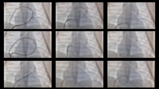 Cateterizzazione del cuore e dei vasi nella radiografia — Video Stock