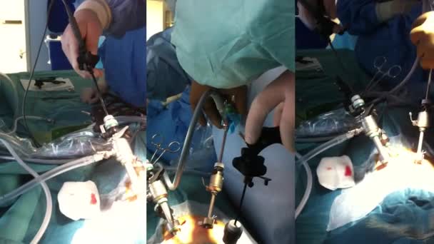 Opération endoscopique. Multicamera — Video