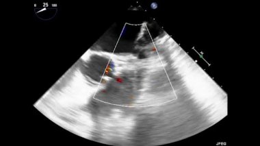 Kalbin transsofageal ultrasonu. Transesophageal Ultrason Ekokardiyografisi.