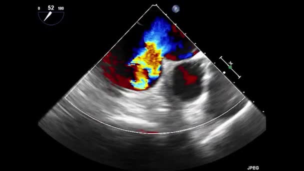 Vídeo Ultra Som Transesofágico Coração Ecocardiografia Por Ultrassom Transesofágico — Vídeo de Stock