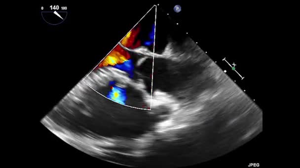 Video Transesophageal Ultrasound Heart Transesophageal Ultrasound Echocardiography — ストック動画